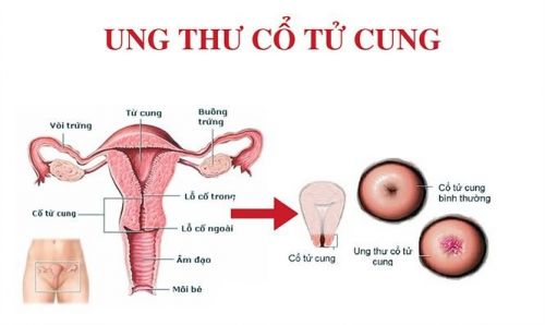 Tại sao các chị em nên tầm soát ung thư cổ tử cung