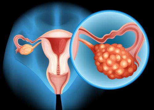 IUI và buồng trứng đa nang: Cơ hội nào cho phụ nữ rối loạn phóng noãn?