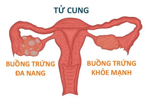 Các bệnh phụ khoa thường gặp ở các chị em