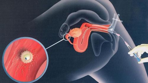IUI thất bại nhiều lần: Đâu là giới hạn và khi nào nên chuyển sang IVF?