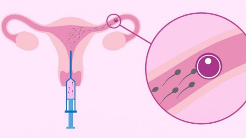 Rụng trứng tự nhiên hay kích trứng trong IUI – đâu là lựa chọn tối ưu?