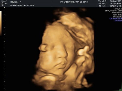 Siêu âm 4D là gì? Khác gì với siêu âm 2D, 3D