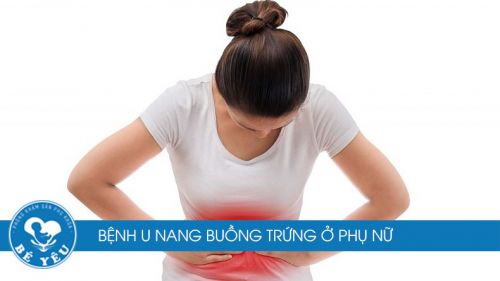 Bệnh u nang buồng trứng ở phụ nữ