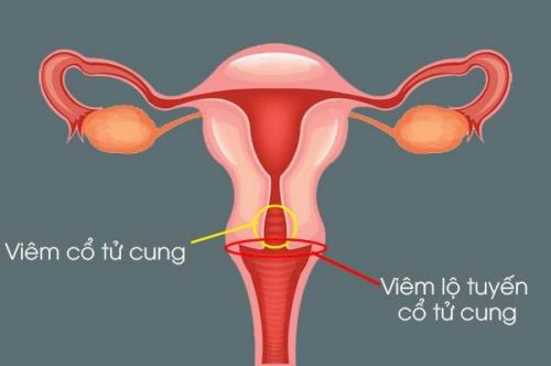 Dịch vụ khám viêm lộ tuyến cổ tử cung tại Biên Hòa