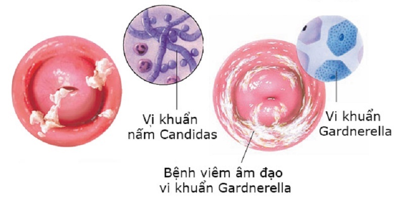 Vi khuẩn gây viêm âm đạo