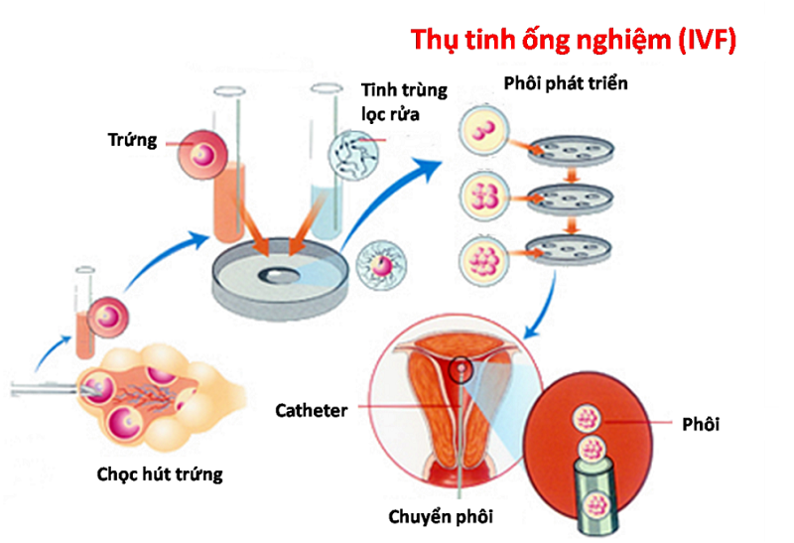 thụ tin ống nghiệm IVF