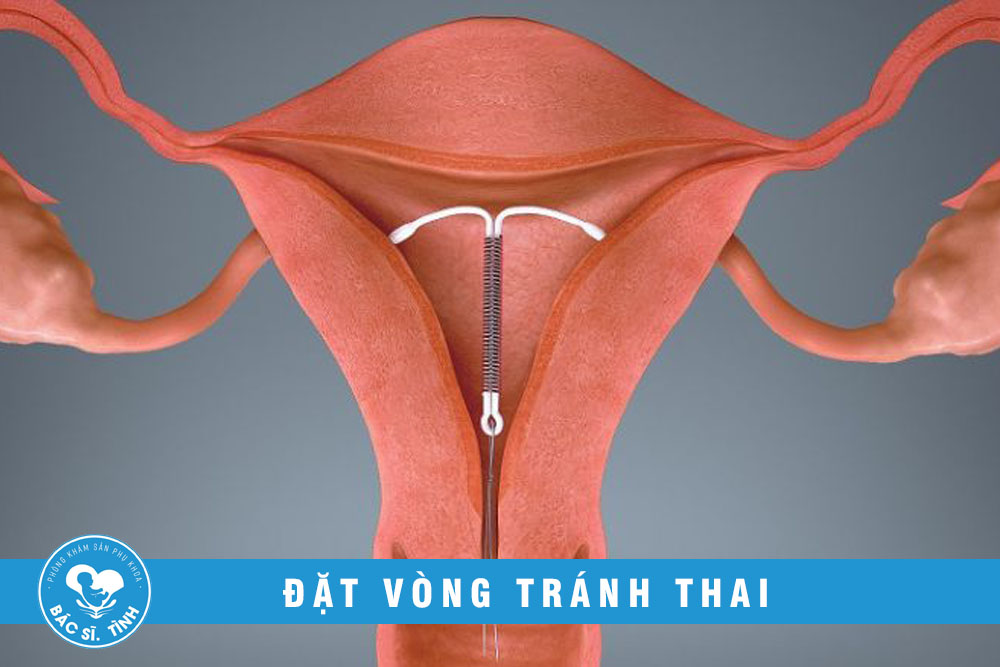 Đặt vòng tránh thai