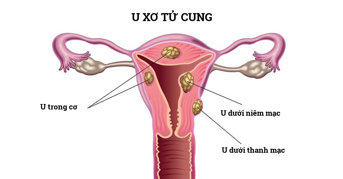 u sơ tử cung