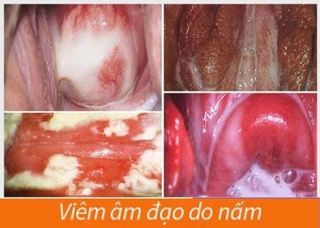 Nấm âm đạo