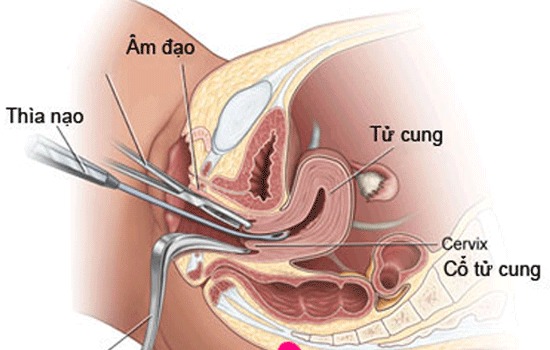 nong và gắp thai