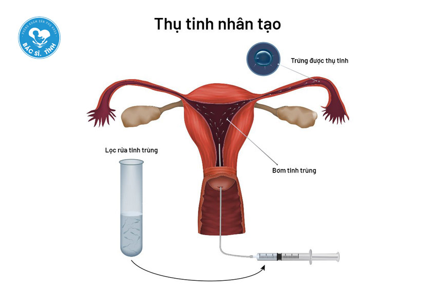 quá trình bơm tinh trùng vào tử cung