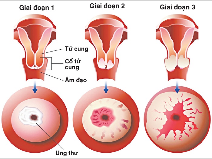 Tầm soát ung thư cổ tử cung giúp phát hiện sớm và tăng khả năng điều trị hiệu quả