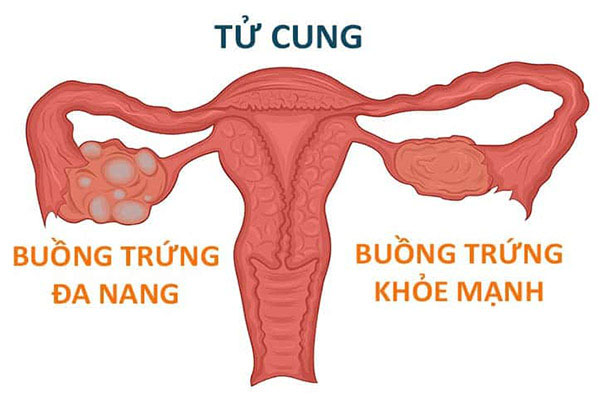 U nang buồng trứng