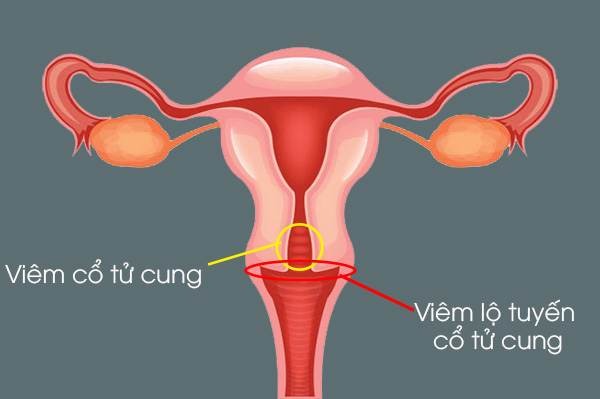 Hình ảnh viêm lộ tuyến cổ tử cung