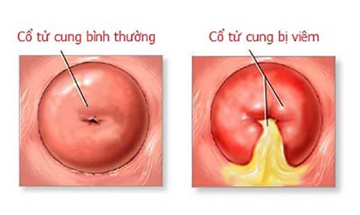 Viêm tử cung